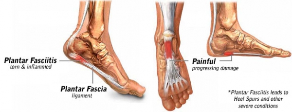 You are currently viewing Plantar Fasciitis – Foot Pain